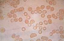 Клетки мишени, тени эритроцитов